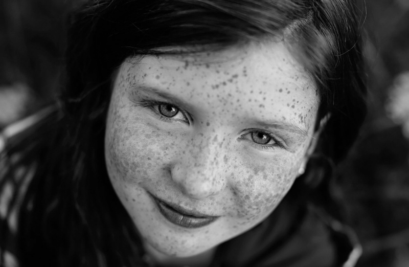 Freckles